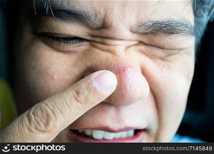 Asian guy taking index finger to large pimple and blackhead pimples and acne scars on him nose