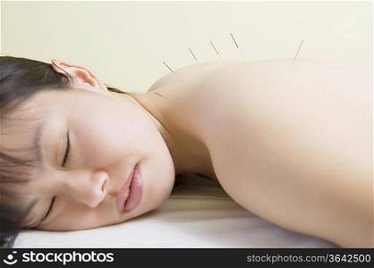 Asian woman lies with acupuncture needles in her back
