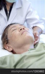 asian woman undergoing of acupuncture beauty face treatment