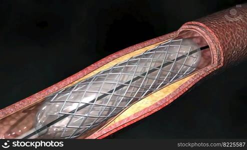 Atherosc≤rosis is a disease in which plaque builds up inside your arteries. 3D illustration. Coronary atherosc≤rosis disease