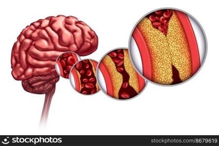 Atherosclerosis And Stroke as a Brain disorder caused by blood cells blocked by fat and cholesterol build up as an artery blockage and hardening of the arteries causing a blockage of blood flow anatomy with 3D render elements.