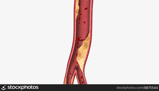 Atherosclerosis is a cardiovascular disease characterized by the gradual buildup of plaque in artery walls. 3D rendering. Atherosclerosis is a cardiovascular disease characterized by the gradual buildup of plaque in artery walls.