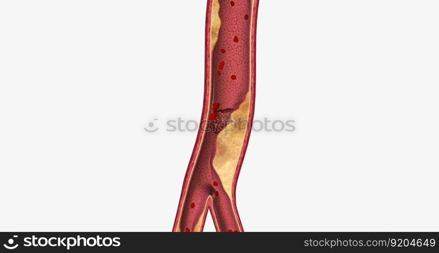 Atherosclerosis is a cardiovascular disease characterized by the gradual buildup of plaque in artery walls. 3D rendering. Atherosclerosis is a cardiovascular disease characterized by the gradual buildup of plaque in artery walls.