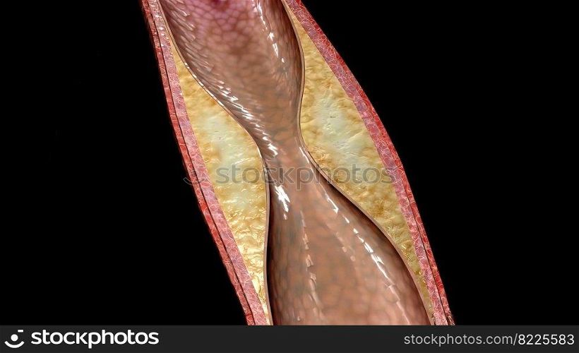 Atherosclerosis is a disease in which plaque builds up inside your arteries. 3D illustration. Coronary atherosclerosis disease