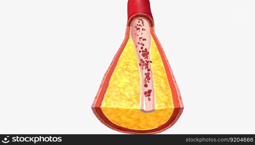 Atherothrombosis is a cardiovascular disease characterized by ruptured atherosclerotic plaque and clot formation. 3D rendering. Atherothrombosis is a cardiovascular disease characterized by ruptured atherosclerotic plaque and clot formation.