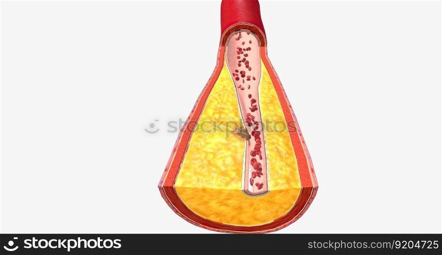 Atherothrombosis is a cardiovascular disease characterized by ruptured atherosclerotic plaque and clot formation. 3D rendering. Atherothrombosis is a cardiovascular disease characterized by ruptured atherosclerotic plaque and clot formation.