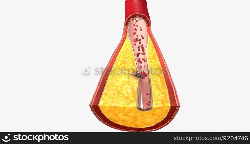 Atherothrombosis is a cardiovascular disease characterized by ruptured atherosclerotic plaque and clot formation. 3D rendering. Atherothrombosis is a cardiovascular disease characterized by ruptured atherosclerotic plaque and clot formation.