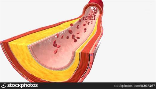 Atherothrombosis is a cardiovascular disease characterized by ruptured atherosclerotic plaque and clot formation. 3D rendering. Atherothrombosis is a cardiovascular disease characterized by ruptured atherosclerotic plaque and clot formation.
