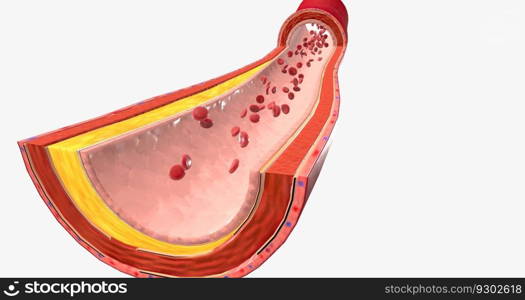 Atherothrombosis is a cardiovascular disease characterized by ruptured atherosclerotic plaque and clot formation. 3D rendering. Atherothrombosis is a cardiovascular disease characterized by ruptured atherosclerotic plaque and clot formation.