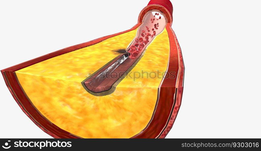 Atherothrombosis is a cardiovascular disease characterized by ruptured atherosclerotic plaque and clot formation. 3D rendering. Atherothrombosis is a cardiovascular disease characterized by ruptured atherosclerotic plaque and clot formation.