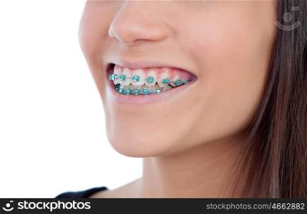Attractive young woman with brackets isolated on a white backgroung
