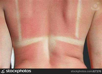 Back burnt after sunburn. Human back burnt after sunburn. Scald of the back by sun's beams