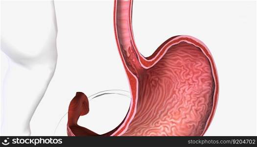 Barretts esophagus is a condition in which the tissue lining the esophagus is replaced by tissue that is similar to the intestinal lining. 3D rendering. Barretts esophagus is a condition in which the tissue lining the esophagus is replaced by tissue that is similar to the intestinal lining.