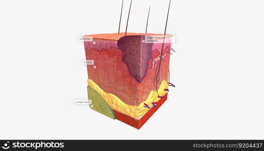 Basal Cell Carcinoma in Tissue, Stage 1 3D rendering. Basal Cell Carcinoma in Tissue, Stage 1