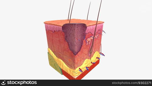 Basal Cell Carcinoma in Tissue, Stage 1 3D rendering. Basal Cell Carcinoma in Tissue, Stage 1