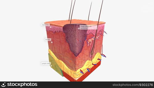 Basal Cell Carcinoma in Tissue, Stage 1 3D rendering. Basal Cell Carcinoma in Tissue, Stage 1