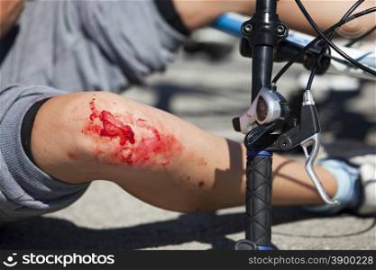 Bicycle fall injuries