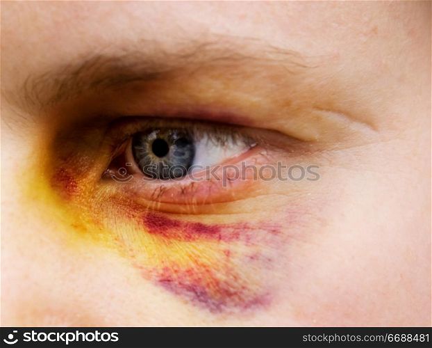 Black eye detail of a woman - purple yellow and black