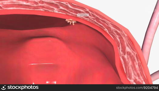 Bladder cancer is a type of cancer that originates in the urothelial cells of the bladder. 3D rendering. Bladder cancer is a type of cancer that originates in the urothelial cells of the bladder.