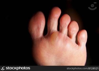 Blisters wounds feet caused by running barefoot.