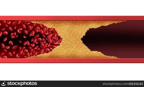 Blocked blood vessel human artery disease with cholesterol buildup clogging or blocking circulation flow with 3D illustration elements.