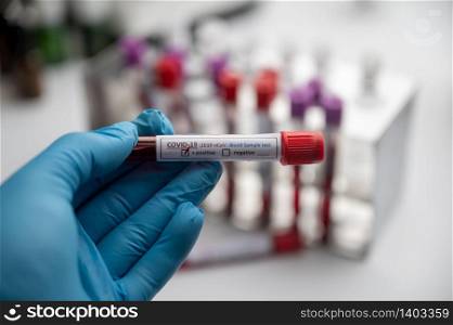 Blood test samples for presence of coronavirus (COVID-19) tube containing a blood sample that has tested positive for coronavirus.