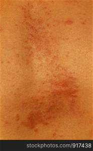 Blurred of skin human have red rash from allergies.