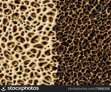 Bone with osteoperosis medical anatomy concept as a strong healthy and normal spongy tissue against unhealthy porous weak skeleton structure due to aging or illness.