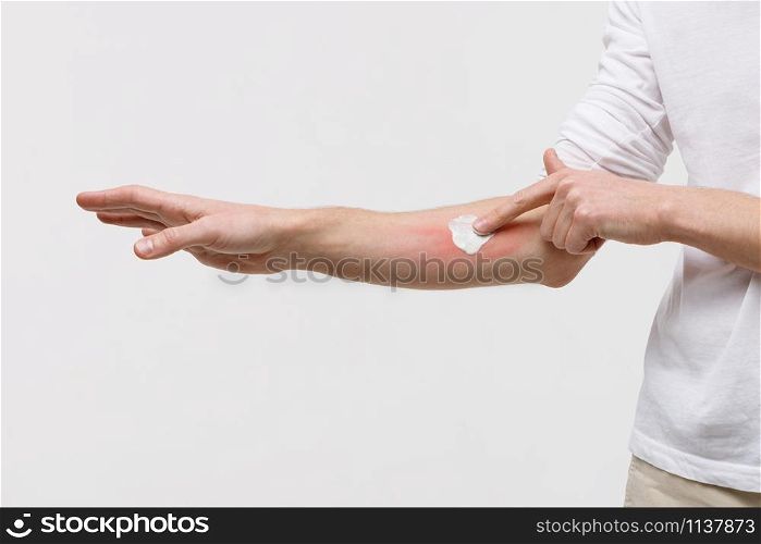 Bouts of allergies concept. Allergic reaction, itch, dermatitis, dry skin. Man is applying cream/ointment on the swell skin against mosquito bites, isolated on white background, close up.