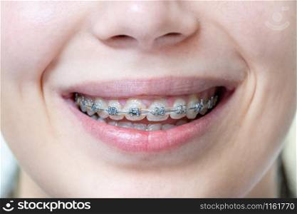 Braces for alignment of teeth on teeth at the woman. Medical dental concept. Close up. Medical dental braces