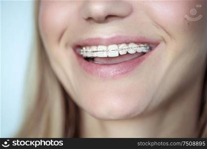 Braces, treatment for a crooked teeth, closeup photo of a beautiful smile of a young woman with white clean teeth, aesthetic dentistry and dental care concept