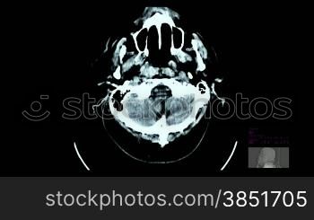 Brain scan, Cerebral venous congestion