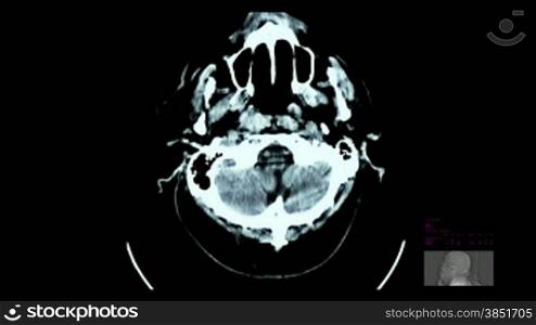 Brain scan, Cerebral venous congestion