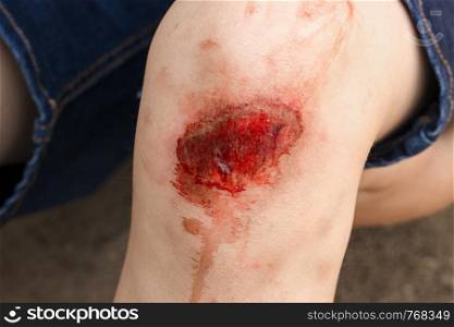 Broken scratched knee child fell off bike, close-up. Broken scratched knee child