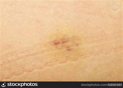 bruises after injection