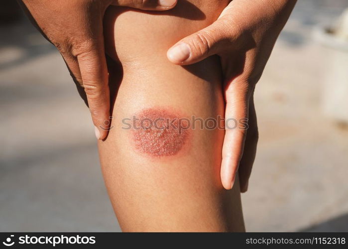 Burning Injuries on leg woman