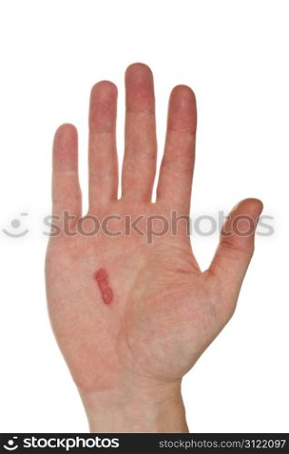 Callus on the male hand. Isolated on white background
