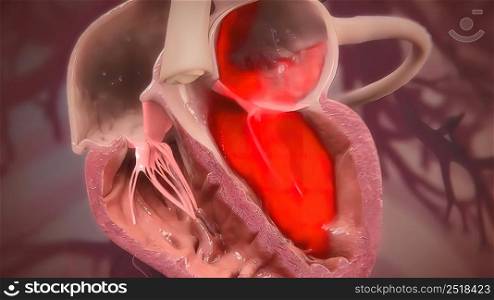 Cardiomyopathy is a disease of the heart muscle that makes it harder for your heart to pump blood to the rest of your body. 3D illustration. Heart muscle disease in human body