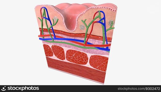 Celiac Disease is a chronic condition characterized an inflammatory allergic response of the digestive tract to Gluten. 3D rendering. Celiac Disease is a chronic condition characterized an inflammatory allergic response of the digestive tract to Gluten.