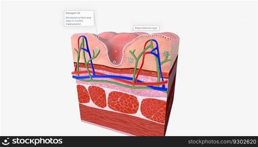 Celiac Disease is a chronic condition characterized an inflammatory allergic response of the digestive tract to Gluten. 3D rendering. Celiac Disease is a chronic condition characterized an inflammatory allergic response of the digestive tract to Gluten.