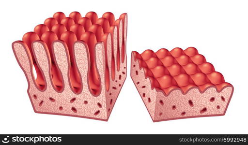 Celiac or coeliac disease anatomy medical concept with normal villi and damaged small intestine lining as an autoimmune disorder of the digestion system as a 3D illustration.