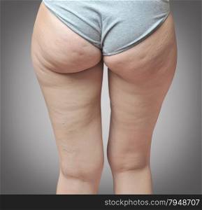 Cellulite at woman buttocks.Gray background