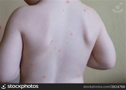 Chickenpox disease. Chickenpox pattern on the skin of a two year old boy