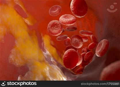 Cholesterol plaque in artery, Blood vessel with flowing blood cells. 3D illustration. Cholesterol plaque in artery