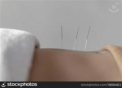 close up acupuncture procedure. Resolution and high quality beautiful photo. close up acupuncture procedure. High quality beautiful photo concept