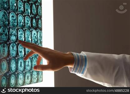 Close-up image of doctor's hand pointing at x-ray results