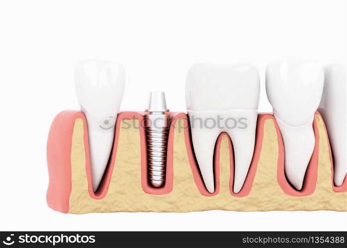 Close up Isolate Process Implants Section on white background. 3D Render