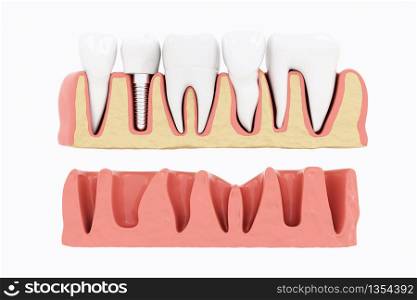 Close up Isolate Process Implants Section with gums on white background. 3D Render