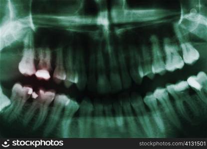Close-up of a dental X-Ray