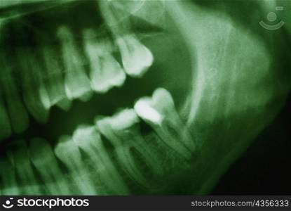 Close-up of a dental X-Ray